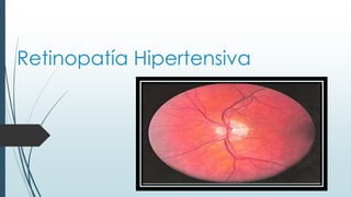 Retinopatía Hipertensiva

 