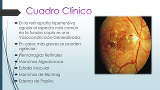  En la retinopatía hipertensiva
aguda el aspecto más común
en la fundos copia es una
Vasoconstricción Generalizada.

 En casos más graves se pueden
apreciar:
 Hemorragias Retínales

 Manchas Algodonosas
 Estrella Macular
 Manchas de Elschnig
 Edema de Papila.

 
