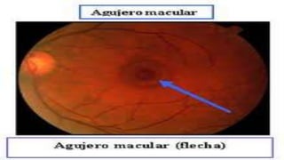 19 transtornos retinianos 2 