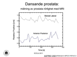 ASTRO 2001 Onk. AW 0111 Dansande prostata: mätning av prostata rörlighet med MRI ECCLU 2011 