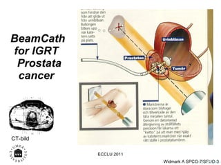 BeamCath for IGRT   Prostata cancer  Onk. AW 9809 CT-bild ECCLU 2011 