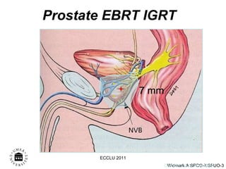 Prostate EBRT IGRT  Onk klin, NUS, A W 0002 7 mm ECCLU 2011 