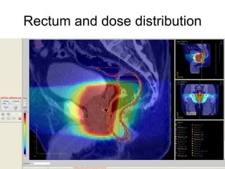 Rectum and dose distribution 