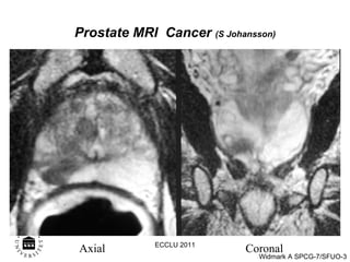 Prostate MRI  Cancer   (S Johansson) Axial Coronal ECCLU 2011 