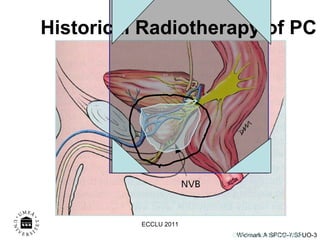 Historical Radiotherapy of PC Onk klin, NUS, A W 0002 ECCLU 2011 