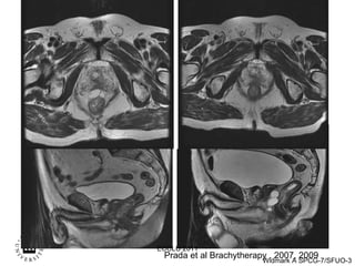 Prada et al Brachytherapy , 2007, 2009 ECCLU 2011 