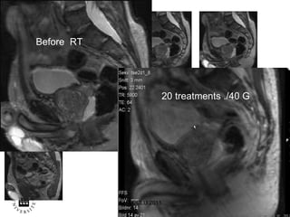 ECCLU 2011 Before  RT 20 treatments ./40 G 