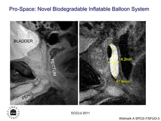 BLADDER PENIS RECTUM ECCLU 2011 Pro-Space: Novel Biodegradable Inflatable Balloon System 
