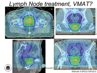 Lymph Node treatment, VMAT? ECCLU 2011 