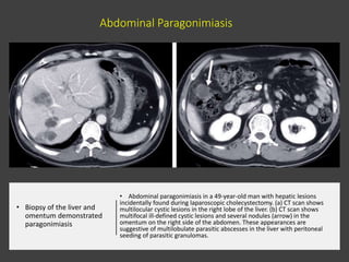 1) Abdomen & Pelvis Radiography for helminthic diseases.pptx