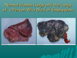 Normal Human Lungs and the LungsNormal Human Lungs and the Lungs
of a Person Who Died of Emphysemaof a Person Who Died of Emphysema
 