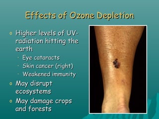 Effects of Ozone DepletionEffects of Ozone Depletion
o Higher levels of UV-Higher levels of UV-
radiation hitting theradiation hitting the
earthearth
• Eye cataractsEye cataracts
• Skin cancer (right)Skin cancer (right)
• Weakened immunityWeakened immunity
o May disruptMay disrupt
ecosystemsecosystems
o May damage cropsMay damage crops
and forestsand forests
 