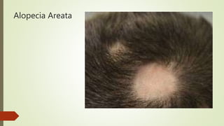 Alopecia Areata
 