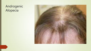 Androgenic
Alopecia
 