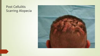Post Cellulitis
Scarring Alopecia
 