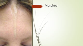 Morphea
 