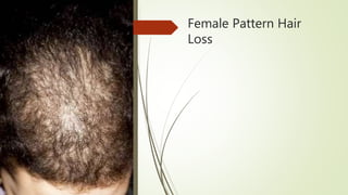 Female Pattern Hair
Loss
 