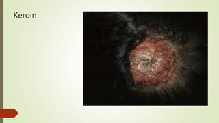 Keroin
 