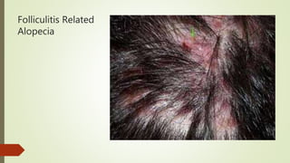 Folliculitis Related
Alopecia
 