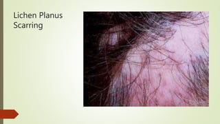 Lichen Planus
Scarring
 