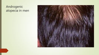 Androgenic
alopecia in men
 
