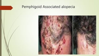 Pemphigoid Associated alopecia
 