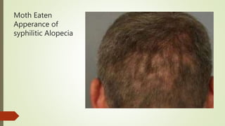 Moth Eaten
Apperance of
syphilitic Alopecia
 