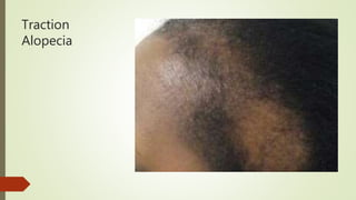 Traction
Alopecia
 