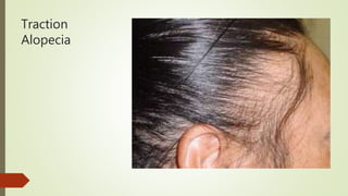 Traction
Alopecia
 