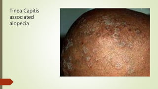 Tinea Capitis
associated
alopecia
 
