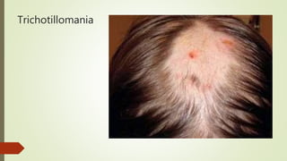 Trichotillomania
 