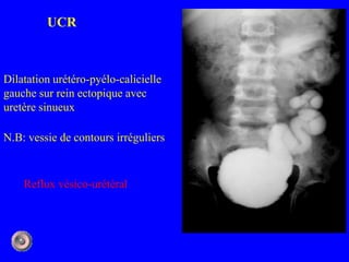 Rein Pyelo 1 anatomie et semiologie rdiologique5 (version5) | PPTX