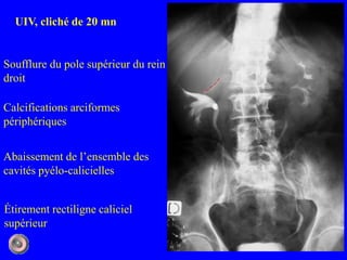 Rein Pyelo 1 anatomie et semiologie rdiologique5 (version5) | PPTX