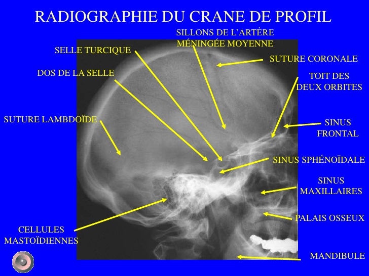 radio-crane-de-face-incision-du-crane-anatomie-vhktx
