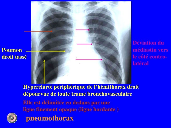 Définition Accentuation De La Trame Broncho Vasculaire