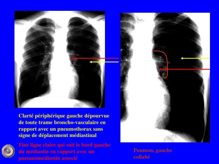 Légère Accentuation De La Trame Bronchique fr.slideshare.net