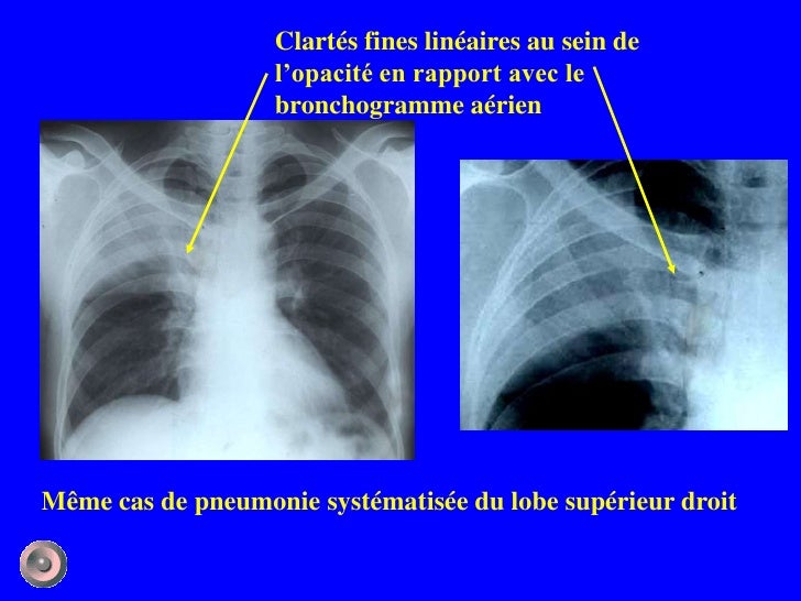 Définition Accentuation De La Trame Broncho Vasculaire