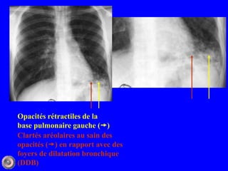 Opacités rétractiles de la
base pulmonaire gauche ()
Clartés aréolaires au sain des
opacités () en rapport avec des
foyers de dilatation bronchique
(DDB)
 