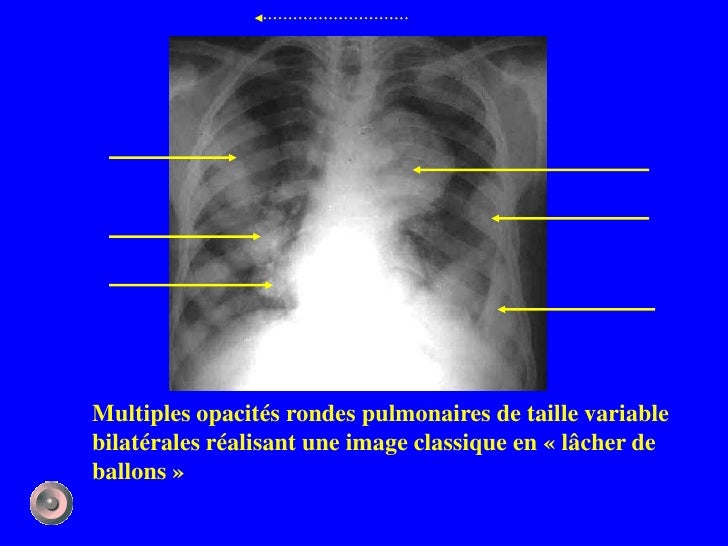 Définition Accentuation De La Trame Broncho Vasculaire