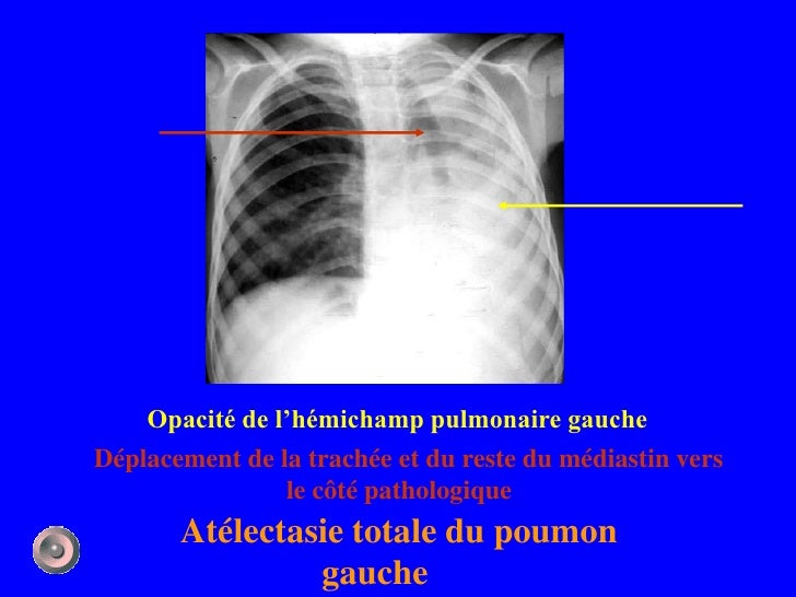 Définition Accentuation De La Trame Broncho Vasculaire