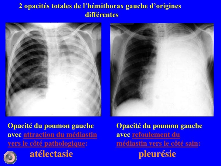 Radio Poumon Accentuation De La Trame Bronchique