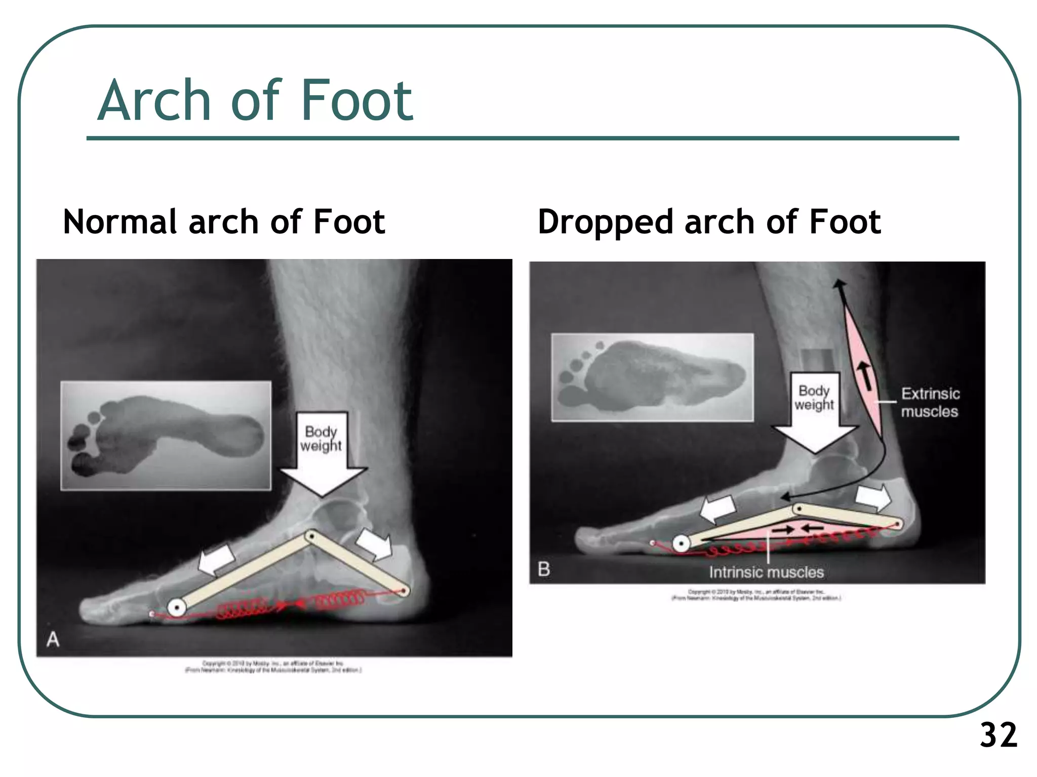 Arch of Foot
Normal arch of Foot Dropped arch of Foot
32
 