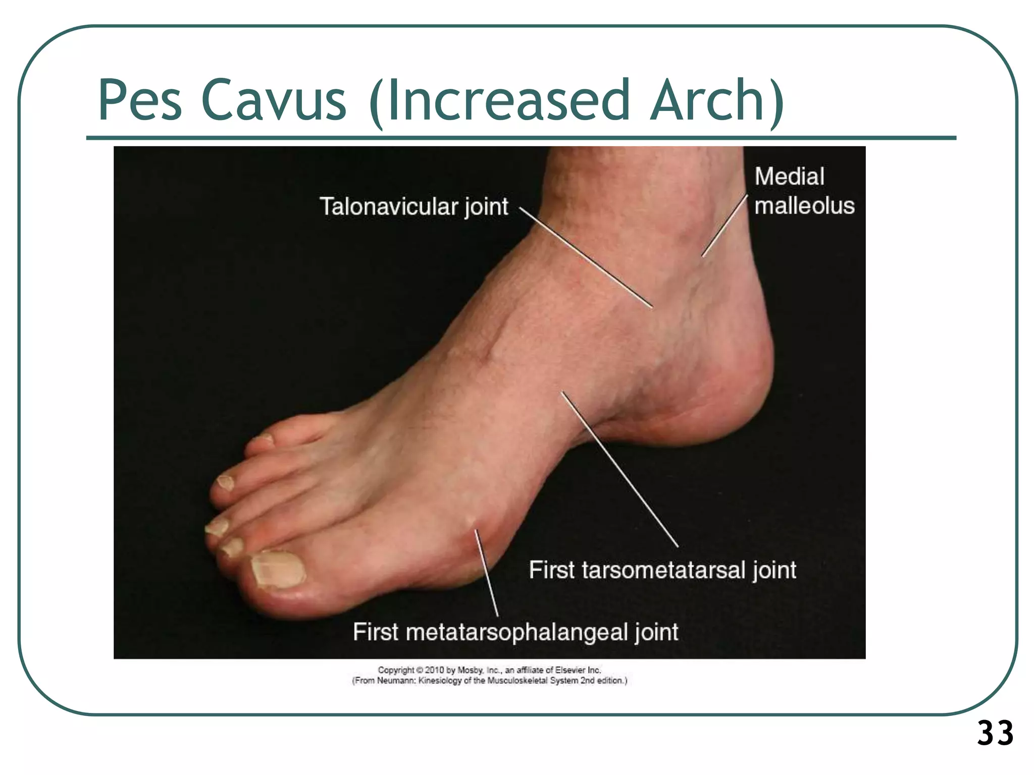 Pes Cavus (Increased Arch)
33
 