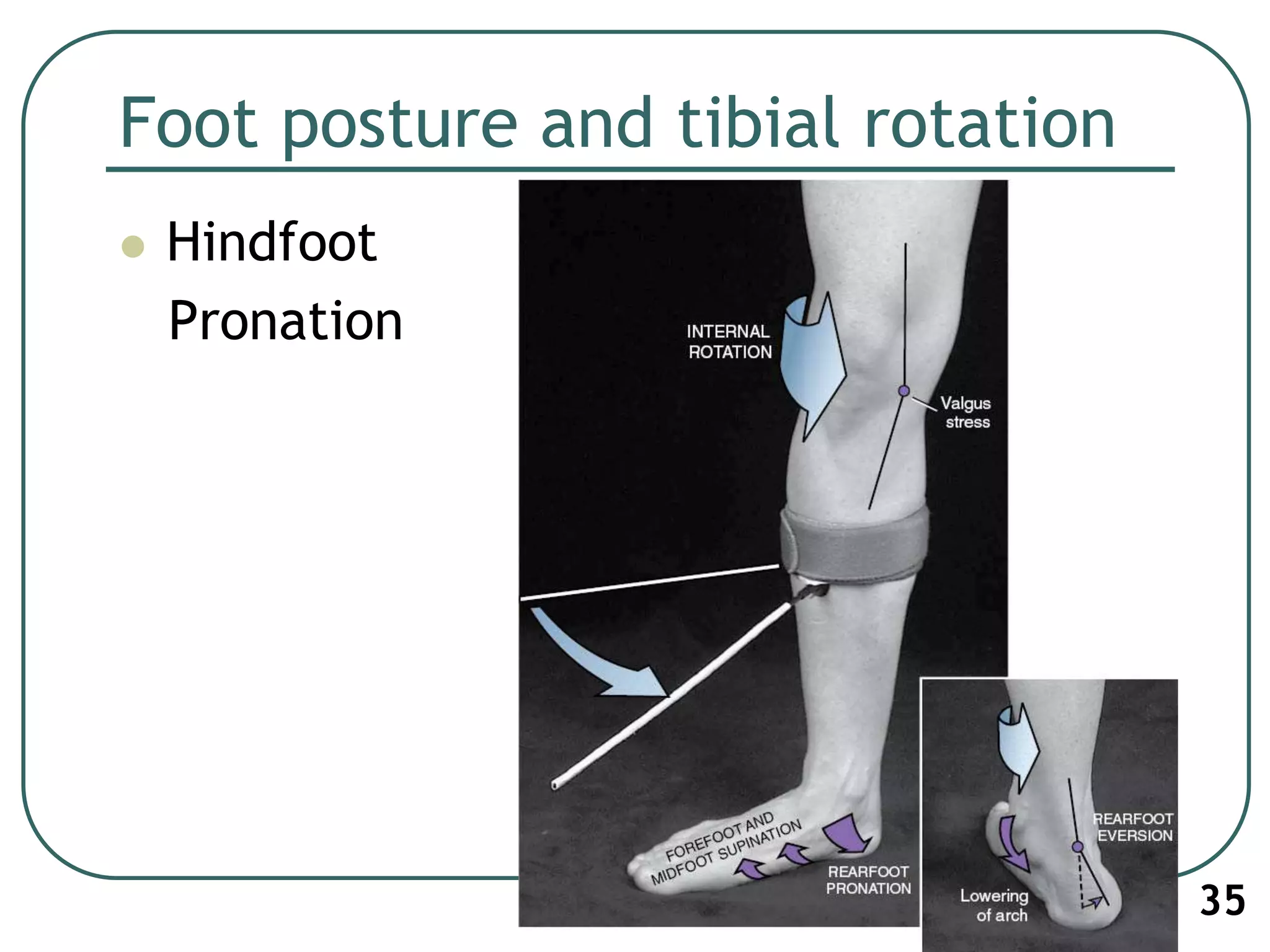 Foot posture and tibial rotation
 Hindfoot
Pronation
35
 