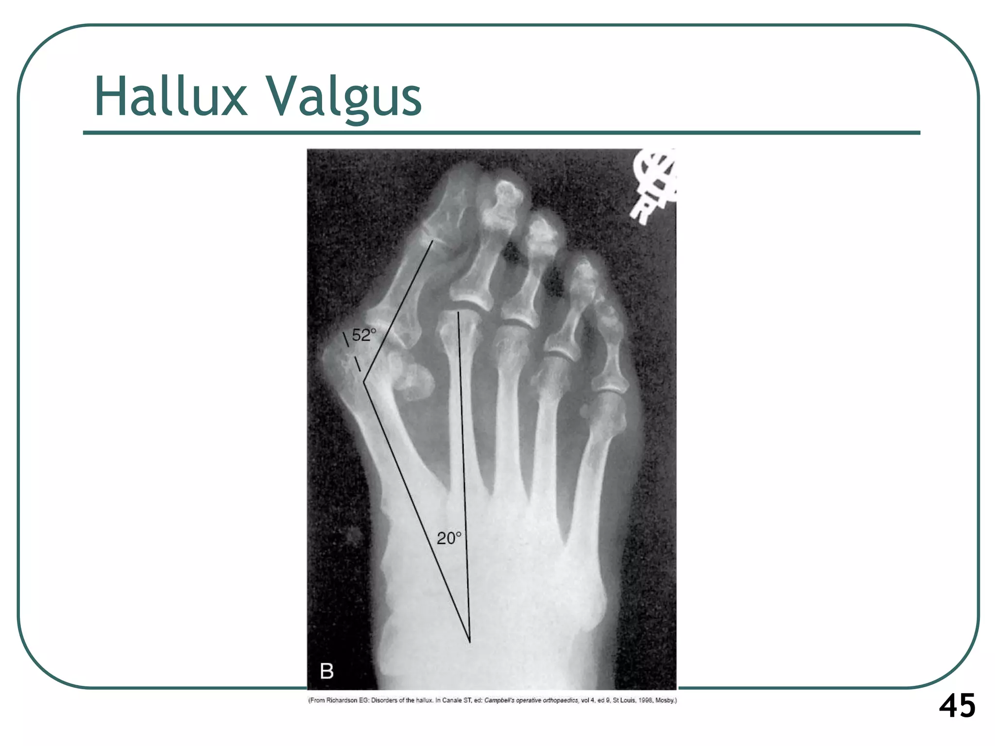 Hallux Valgus
45
 