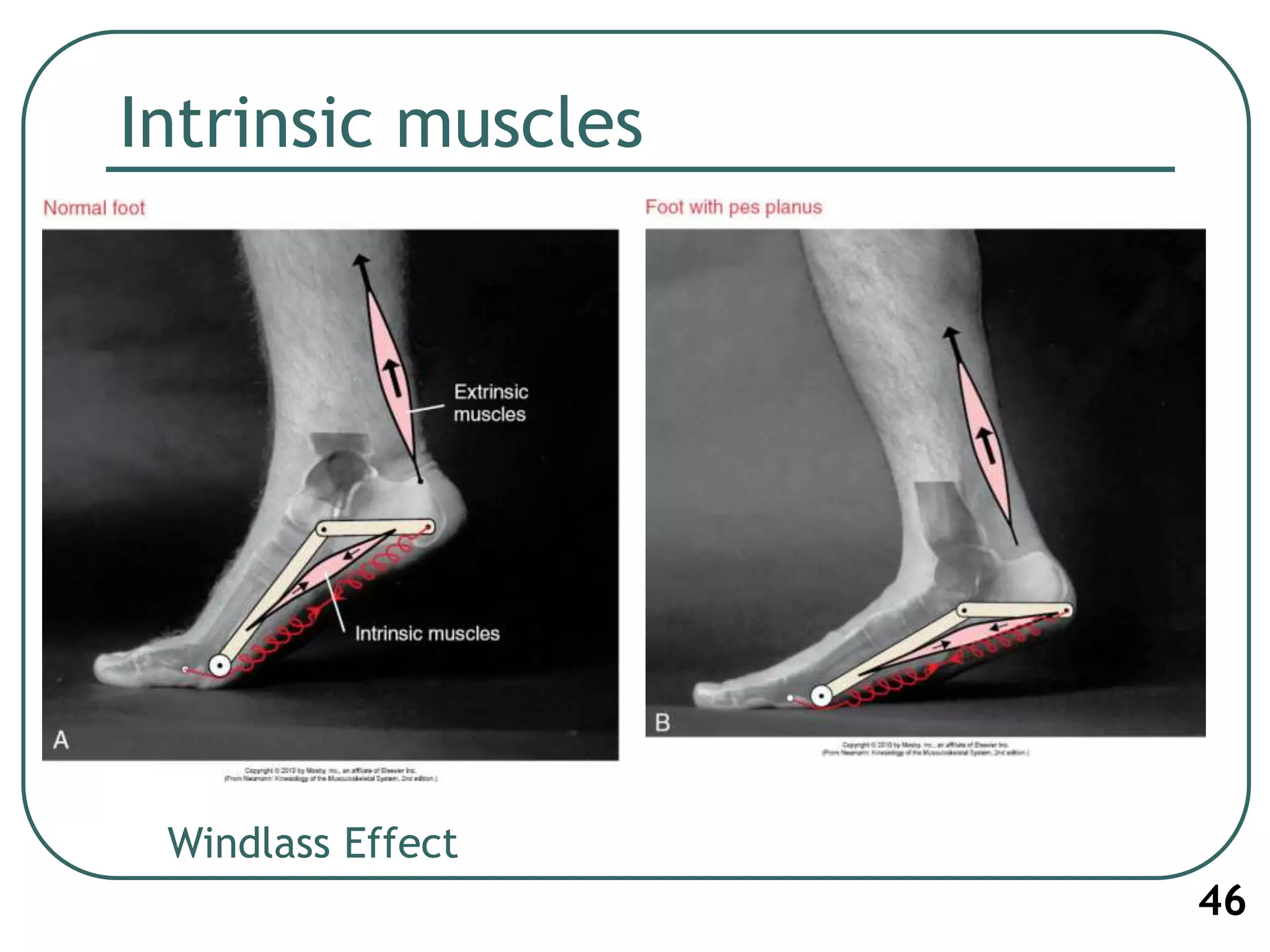 Intrinsic muscles
46
Windlass Effect
 