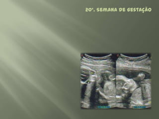 20ª. Semana de Gestação
 