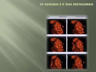 34 Semanas e 5 dias Gestacionais
 