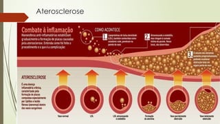 Aterosclerose
 