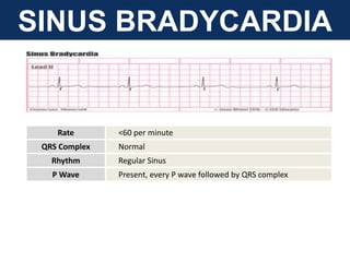 SINUS BRADYCARDIA
Rate <60 per minute
QRS Complex Normal
Rhythm Regular Sinus
P Wave Present, every P wave followed by QRS complex
 
